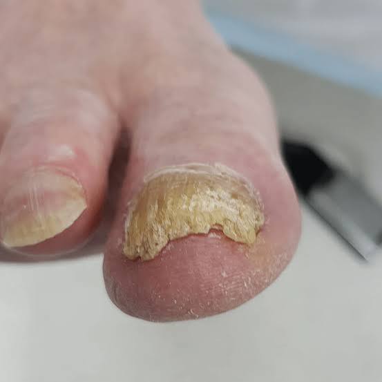 Toenail fungal infection photo